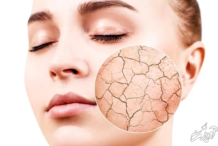 خشکی پوست از عوارض لیف زدن صورت خشکی پوست